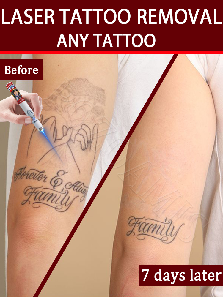 Nano-Laser-Tattooentfernungsst - Laser Toner Powder review and price